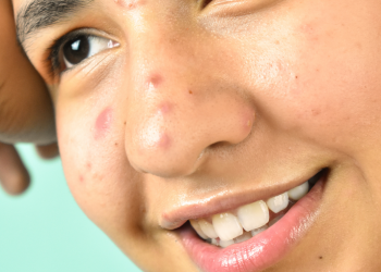 bump on lip
