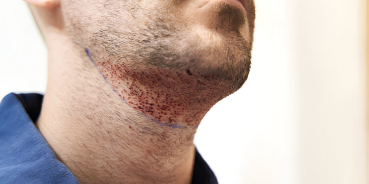 FUE beard transplant